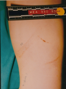 Mark on Stevie's leg, possibly made by edge of the board found at crime scene